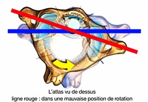 Effets immédiats post remise en place de l’Atlas